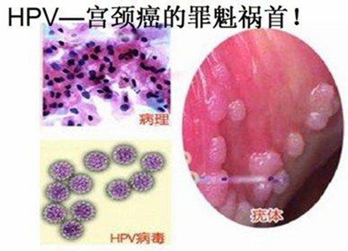 HPV病毒创新治疗方案解析