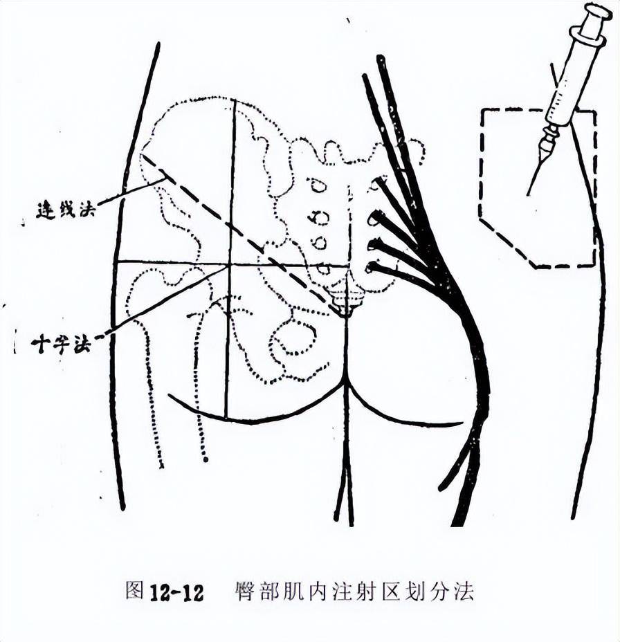 最新臀部注射教学视频